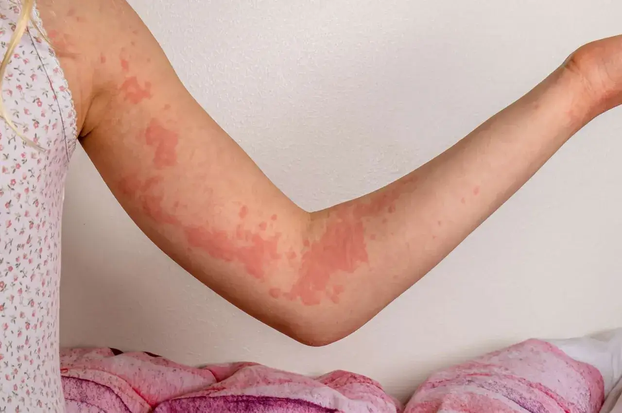 Bras d'enfant couvert de plaques rouges et de boutons allergie, signe d'une r&eacute;action cutan&eacute;e.