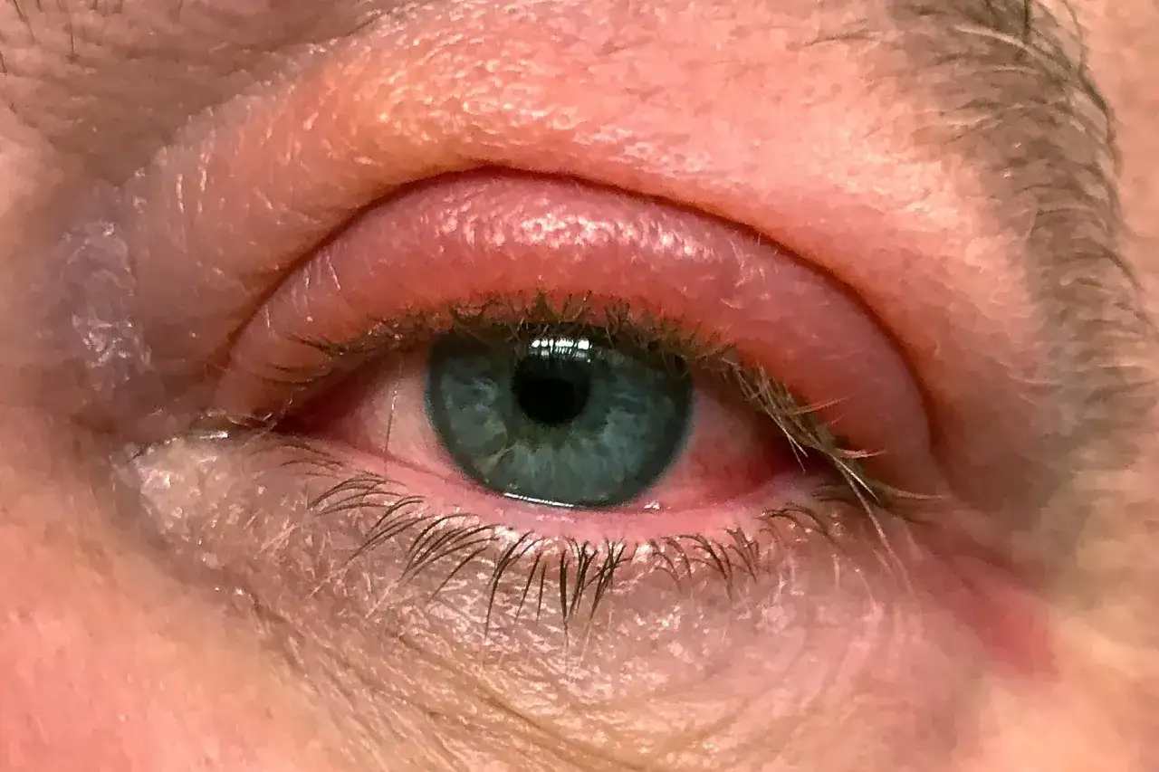 &OElig;il avec une tache rouge sur la paupi&egrave;re sup&eacute;rieure, le blanc de l'&oelig;il est &eacute;galement rouge.