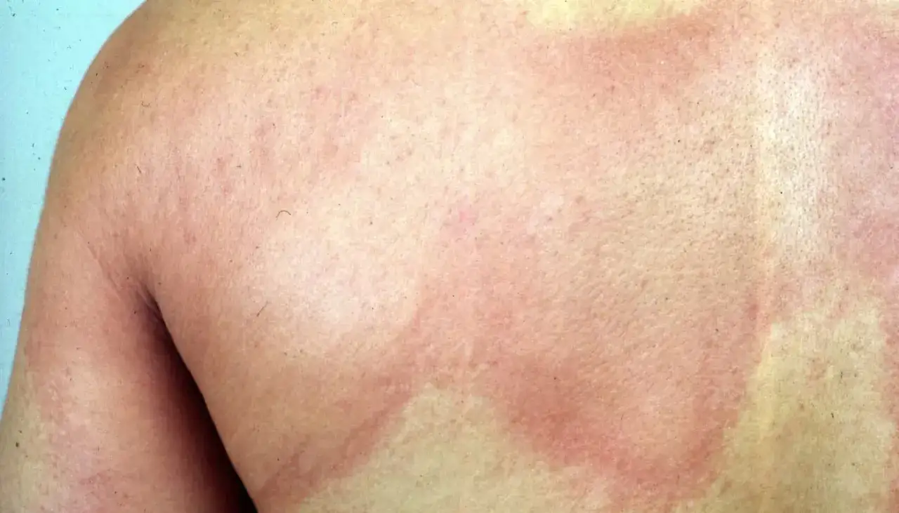Peau rougie et enflamm&eacute;e, pr&eacute;sentant des plaques d'urticaire. Recherche d'un urticaire traitement naturel pour apaiser ces rougeurs.