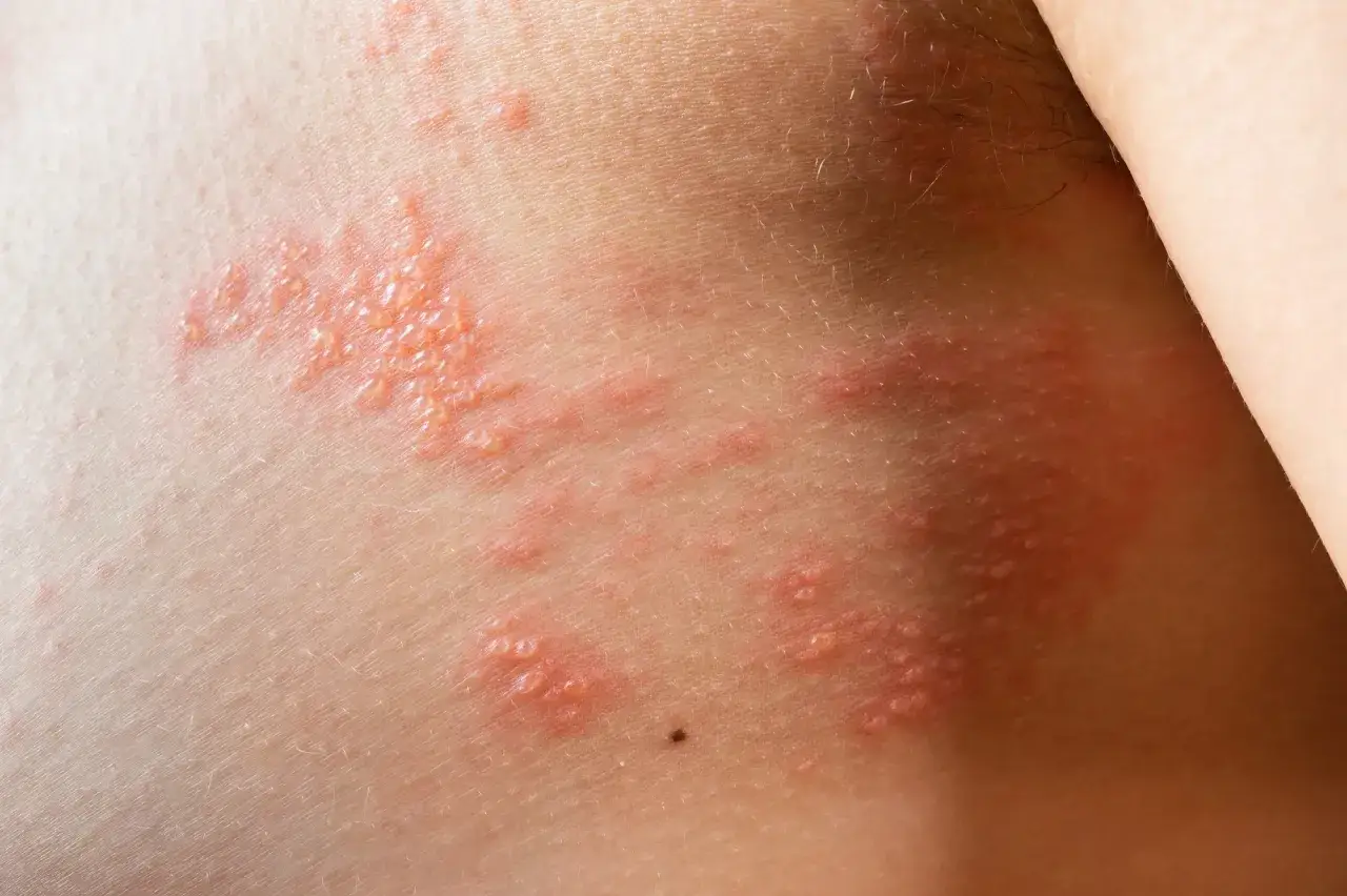 &Eacute;ruption cutan&eacute;e rouge avec des v&eacute;sicules, possiblement une cicatrice zona sur la peau.