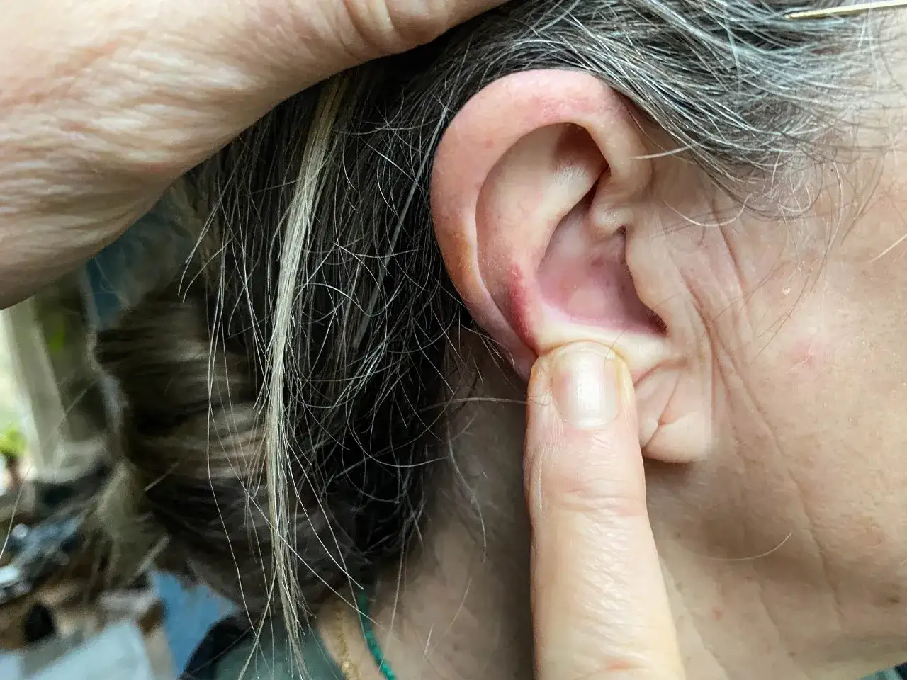 Un doigt pointe une rougeur et un petit point noir sur le lobe de l'oreille.