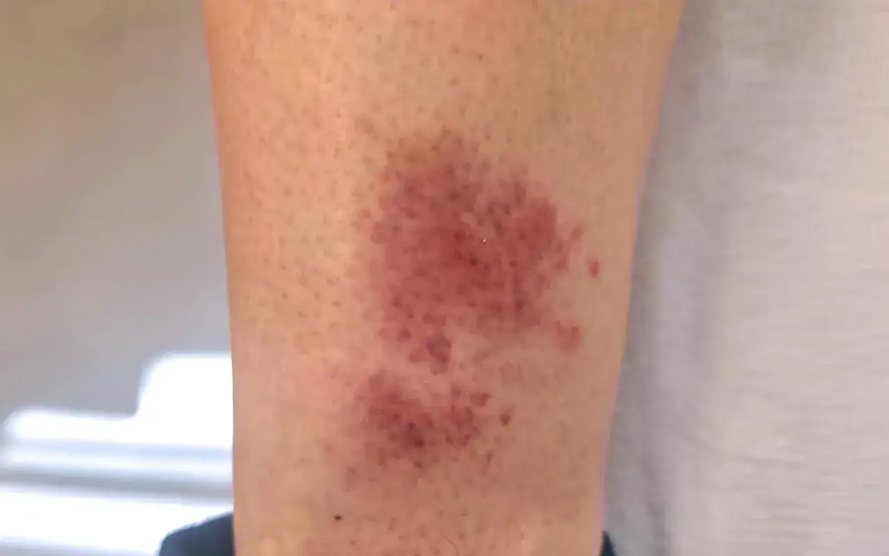 Gros plan d'une plaque rouge sur les jambes, semblant &ecirc;tre une &eacute;ruption cutan&eacute;e ou une ecchymose.