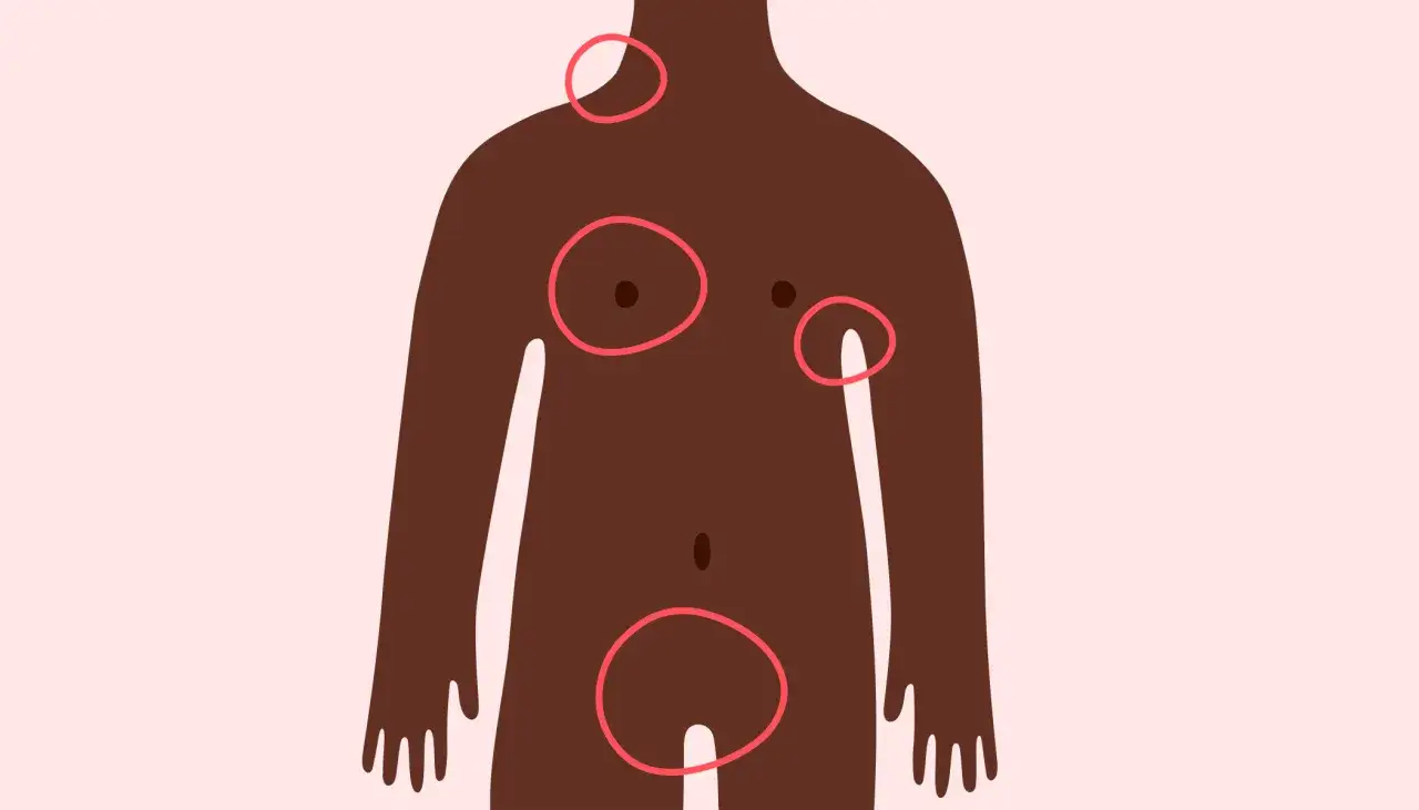 Illustration d'un torse humain avec des cercles rouges indiquant des zones d'int&eacute;r&ecirc;t, possiblement un bouton dur sous la peau.