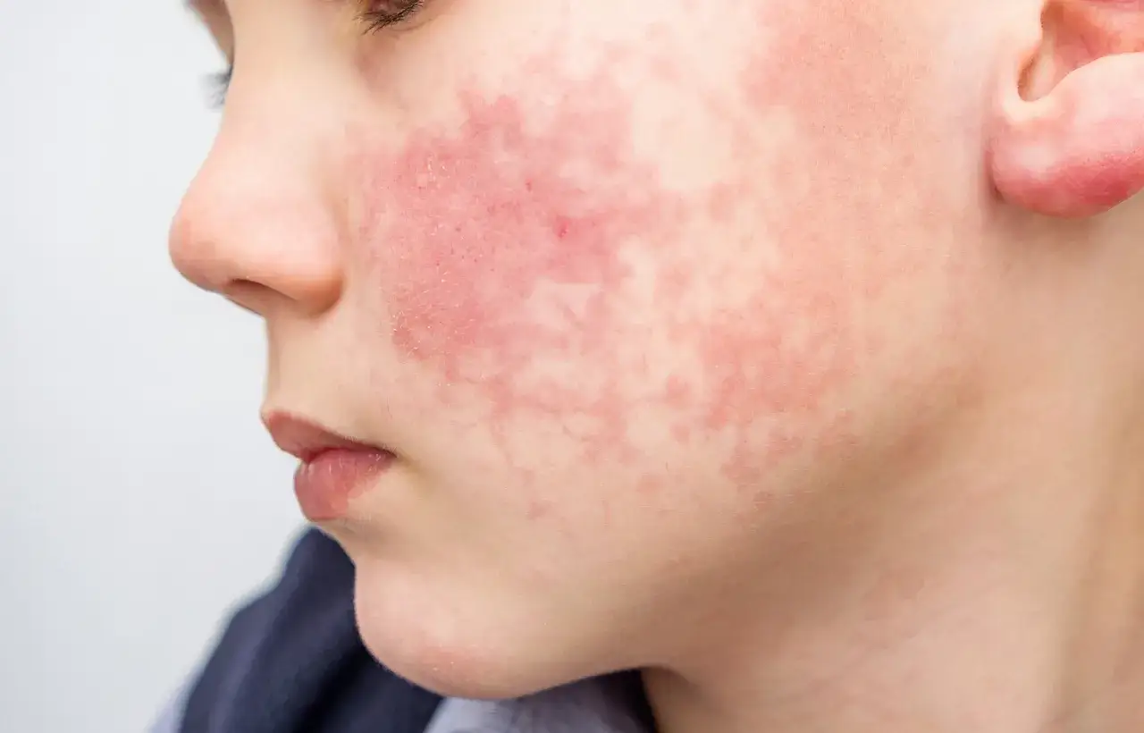 Visage d'enfant pr&eacute;sentant une rougeur et des plaques, possiblement une allergie au soleil.