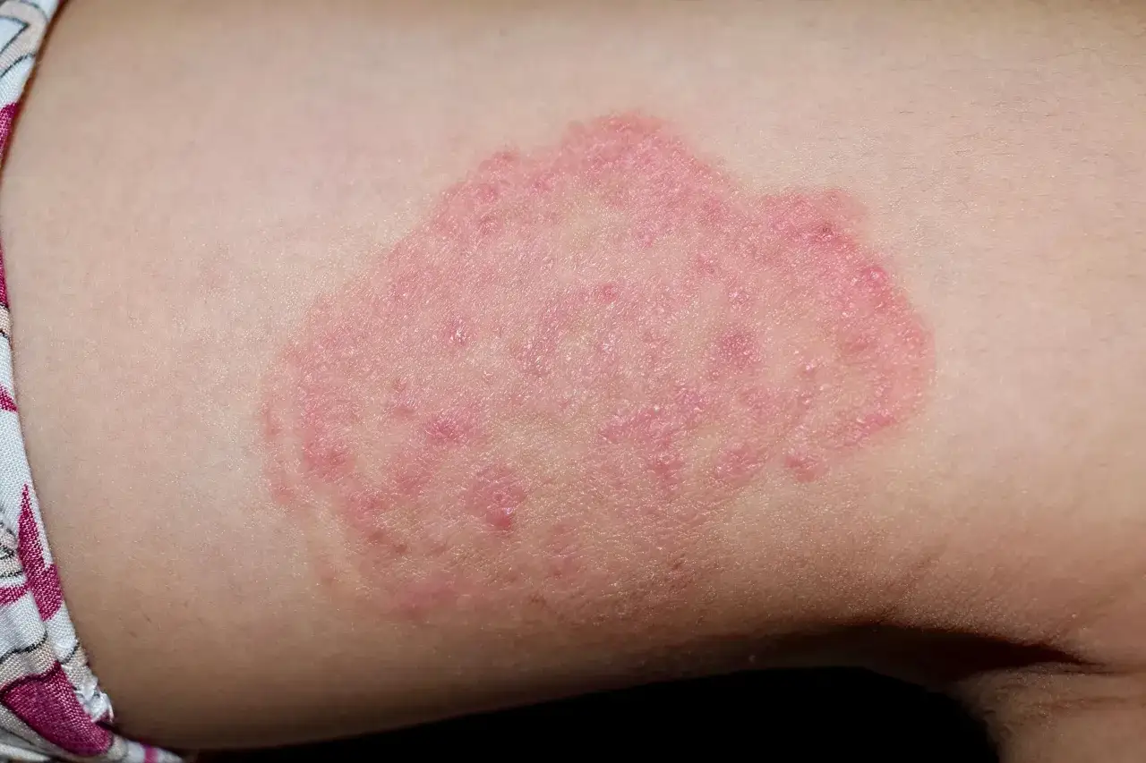 Plaque rouge et irritée sur la peau, symptôme d'eczéma sur le corps.