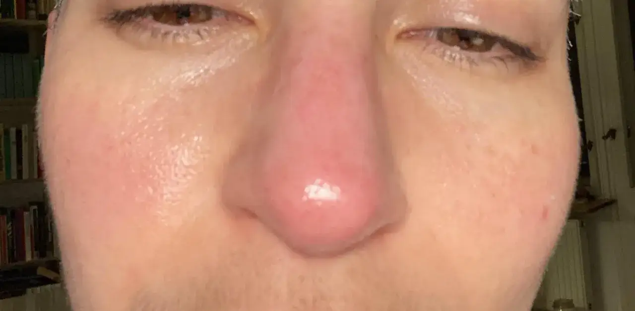 Gros plan sur un visage, mettant en évidence un nez rouge en permanence, avec des yeux marron et des joues rosées.