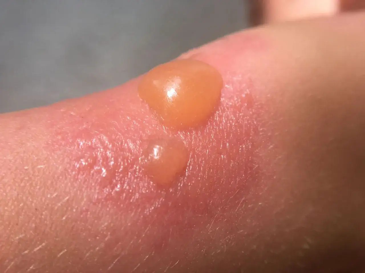Une petite cloque d'eau sur la peau, signe d'une br&ucirc;lure due au soleil. La peau est rouge et gonfl&eacute;e.