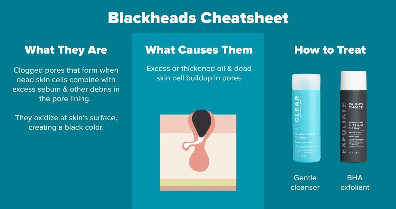Illustration d'un pore obstrué par des cellules mortes et du sébum, cause des pores bouchés et points blancs. Traitements : nettoyant doux et exfoliant BHA.