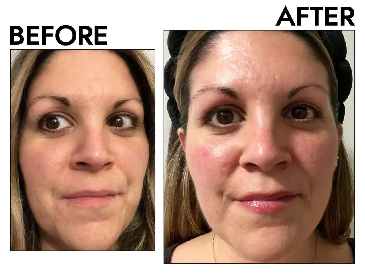 Avant/apr&egrave;s : le visage d'une femme avant et apr&egrave;s l'utilisation de r&eacute;tinol. La peau semble plus lisse et plus lumineuse apr&egrave;s.