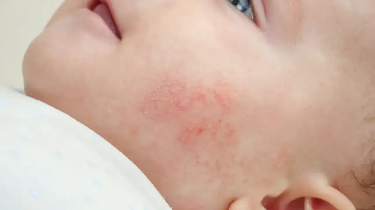 Un petit bouton rouge sur le visage d'un bébé, signe d'une peau sensible.
