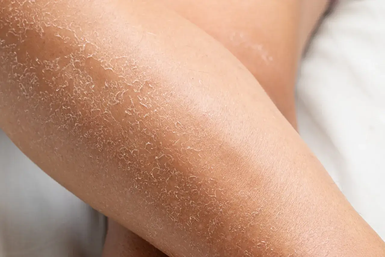 Gros plan sur des jambes sèches, la peau craquelée ressemble à celle d'un lézard.