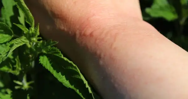 Une peau rougie et boursouflée suite à une piqure d'ortie. Des feuilles vertes d'ortie sont visibles sur le côté.
