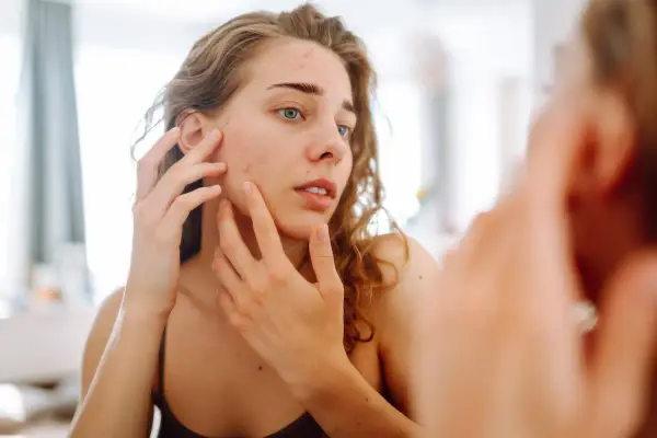 Jeune femme examinant son visage dans le miroir, préoccupée par son acné. Le soleil peut parfois aggraver ces imperfections cutanées.