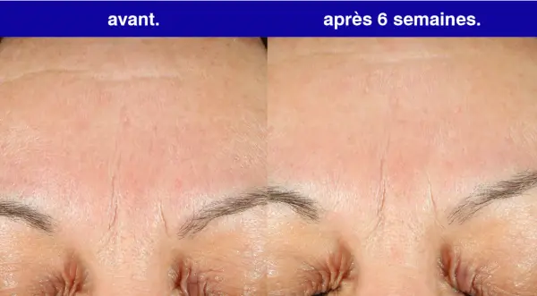 Front du visage avant et après 6 semaines d'utilisation de rétinol. Les rides sont visiblement atténuées.