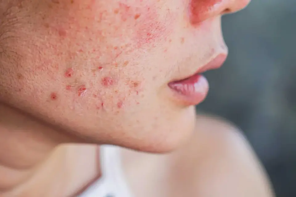Rosacée papulo-pustuleuse - Calmez votre peau durablement